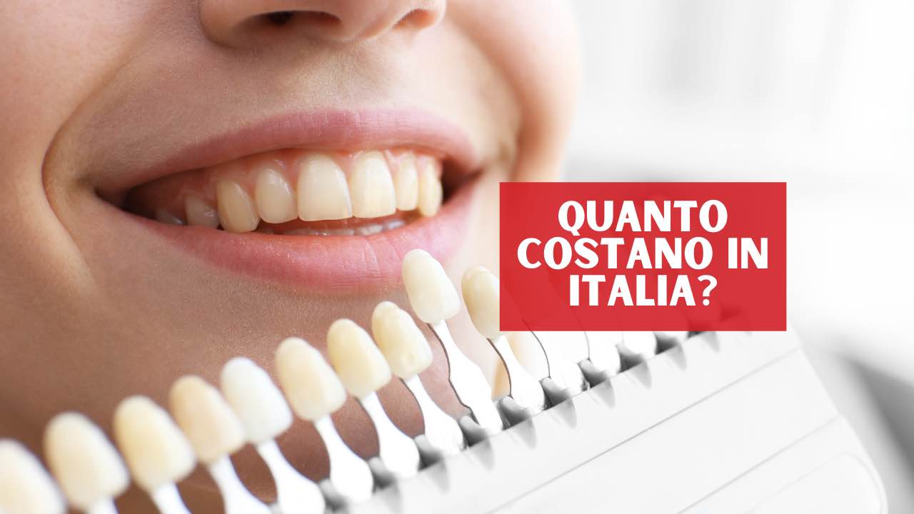 Faccette dentali